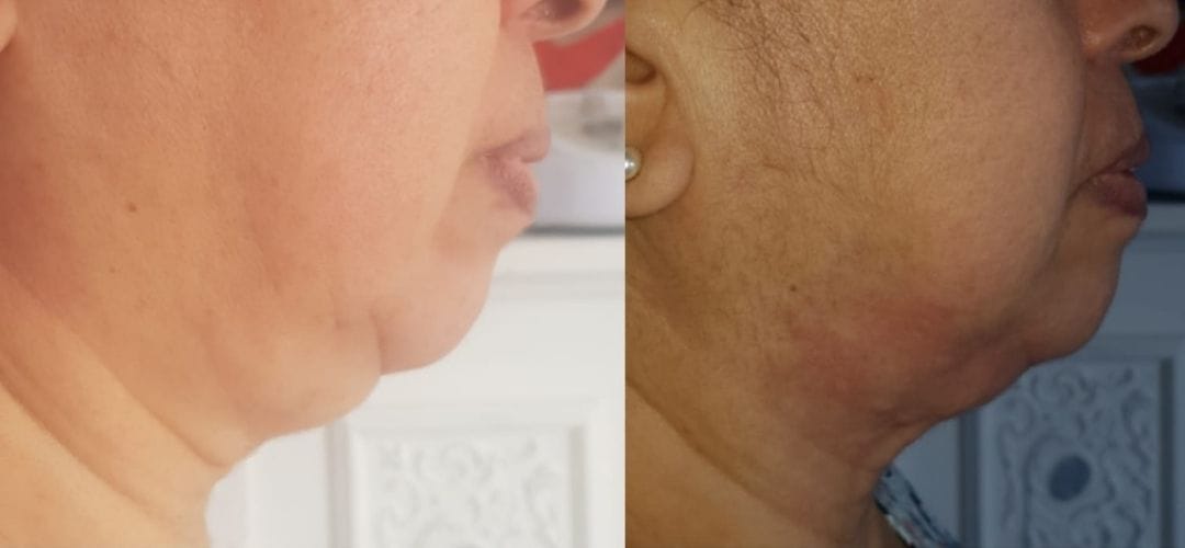 lipodissolution-miss-dalya-beauty-91-athis-mons